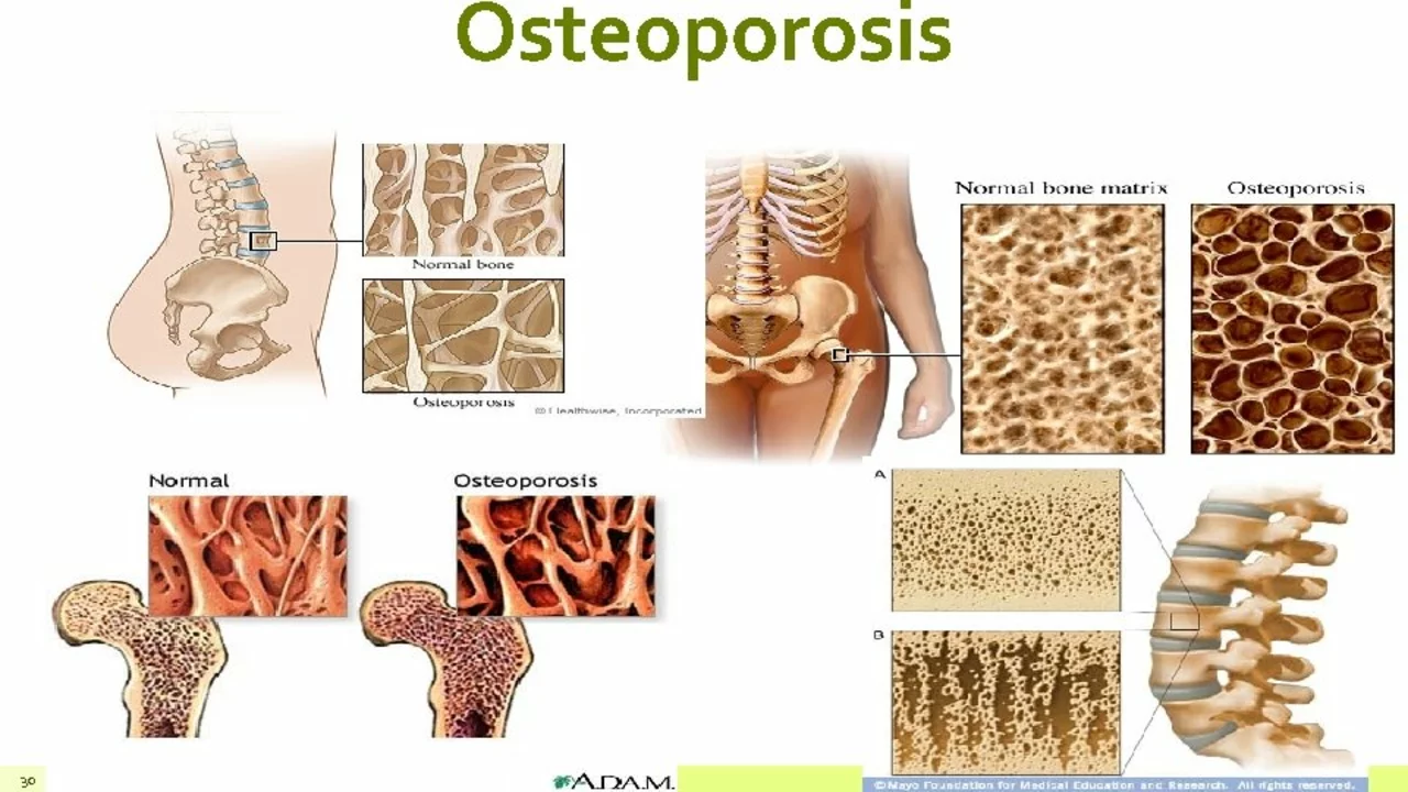 Hyperprolactinaemia and Osteoporosis: Understanding the Risks